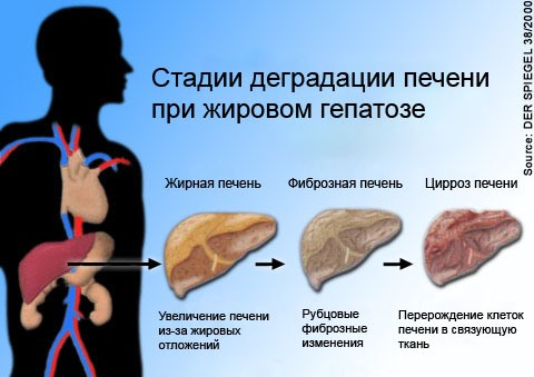 Promena jetri kod hepatoze