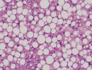 Masna jetra - prvi stadijum hepatoze
